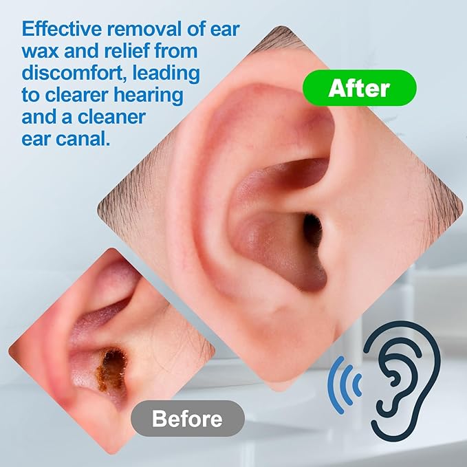Ear Wax Removal Kit, Safe Effective and Easy Ear Cleaner, Ears Irrigation Flushing System, Ears Cleaning Kits for Adults & Kids, Earwax Removal Tools, Earwax Cleaner Tool Set - 30 Tips, Basin, Towel